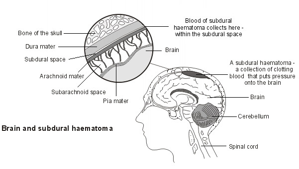 subdural haematoma